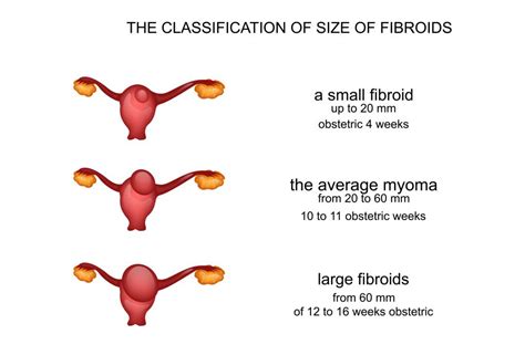 Medium - Size of a plum to an orange. . Which size of fibroid is dangerous in mm